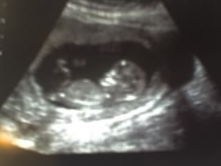 12-week scan (phone photo)