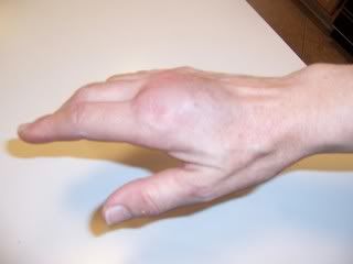 swollen hand Pictures, Images and Photos